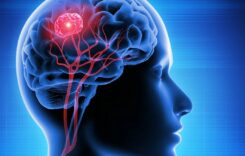 All About Brain Tumours: Causes, Signs, and Methods of Treatment