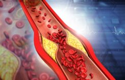 Symptoms of Morning Clogged Arteries: 5 Natural Ways to Treat Heart Blockage Without Surgery