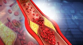 Symptoms of Morning Clogged Arteries: 5 Natural Ways to Treat Heart Blockage Without Surgery